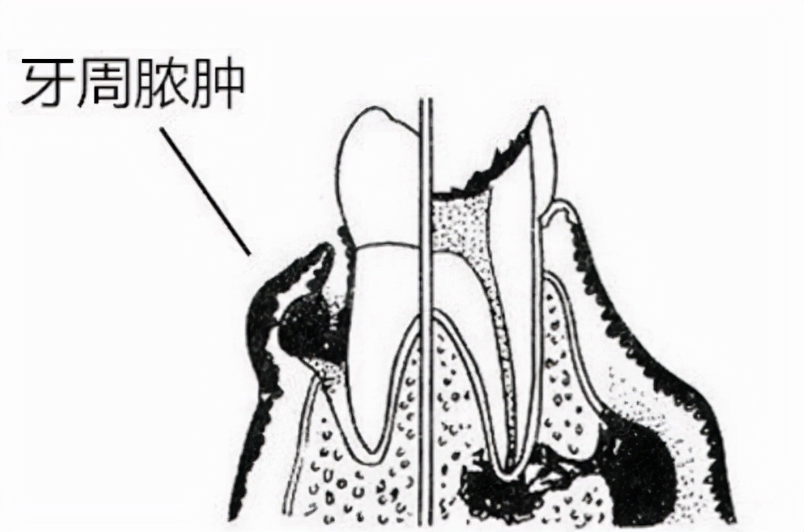 牙龈红肿疼痛怎么治有效,牙龈红肿疼痛的解决办法