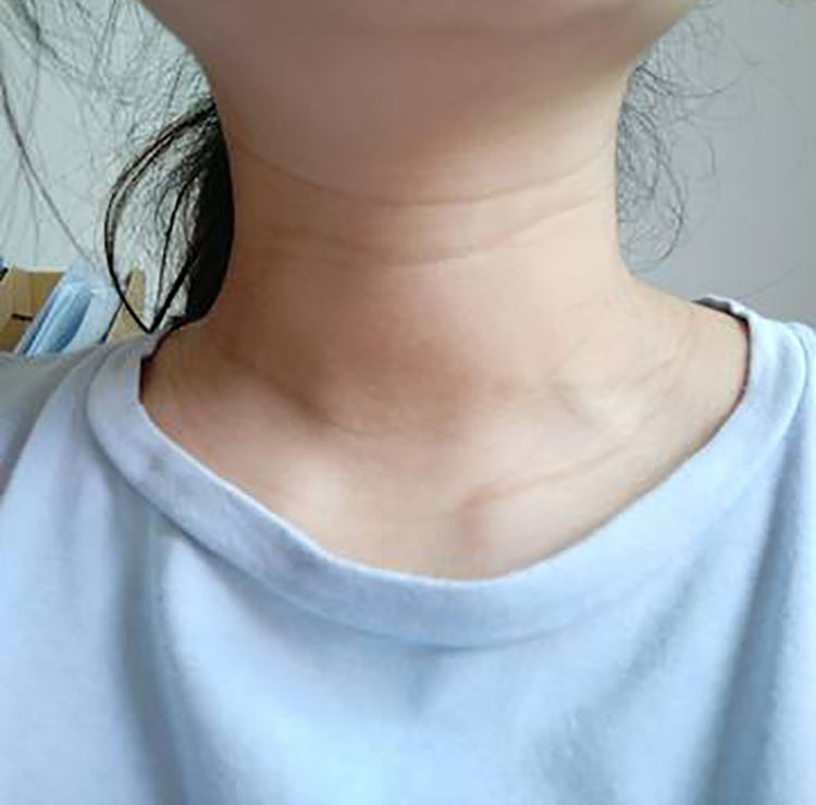 出现颈纹怎么办如何有效消除颈纹,颈纹怎么消除简单方法淡化颈纹