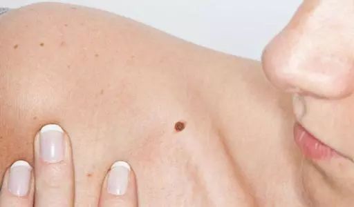 辟谣丨激光点痣不可取,小心“点”出恶性黑色素瘤！5步判断恶性痣