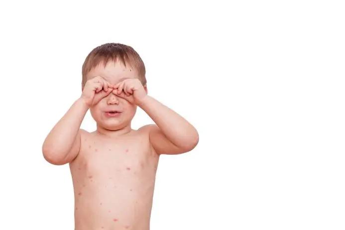 水痘高发期宝妈必知战痘攻略,水痘高发季这波操作助你轻松战痘