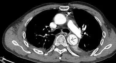 磁共振可以替代cta检查主动脉夹层,主动脉夹层cta上如何分辨真假腔