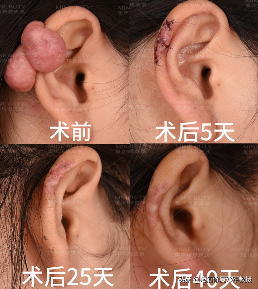 耳朵上的瘢痕疙瘩可以用线勒掉吗,耳朵疤痕疙瘩手术多少钱