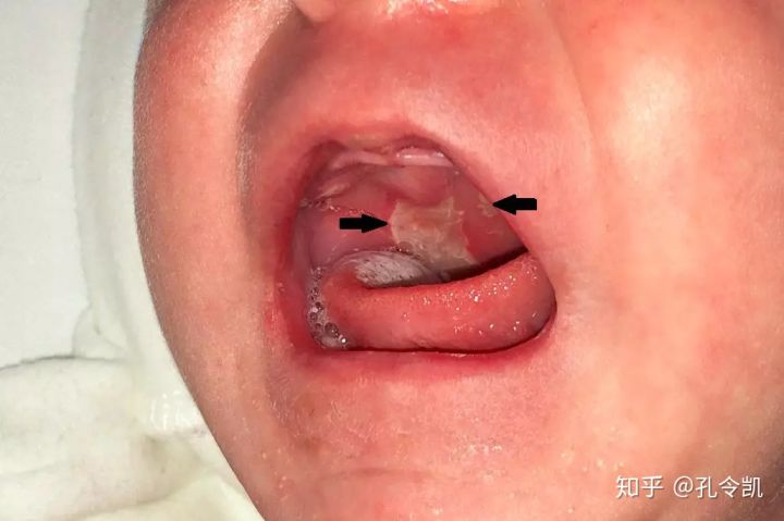 喂奶方式不正确宝宝会呛奶吗,喂奶方法不对会肠胀气吗