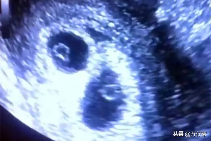 连载（三）｜圆圈妈双胞胎怀孕过程第6周