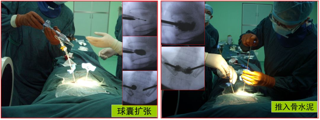 腰椎压缩骨折椎体成形术啥时候做,骨质疏松骨折椎体成形术操作步骤
