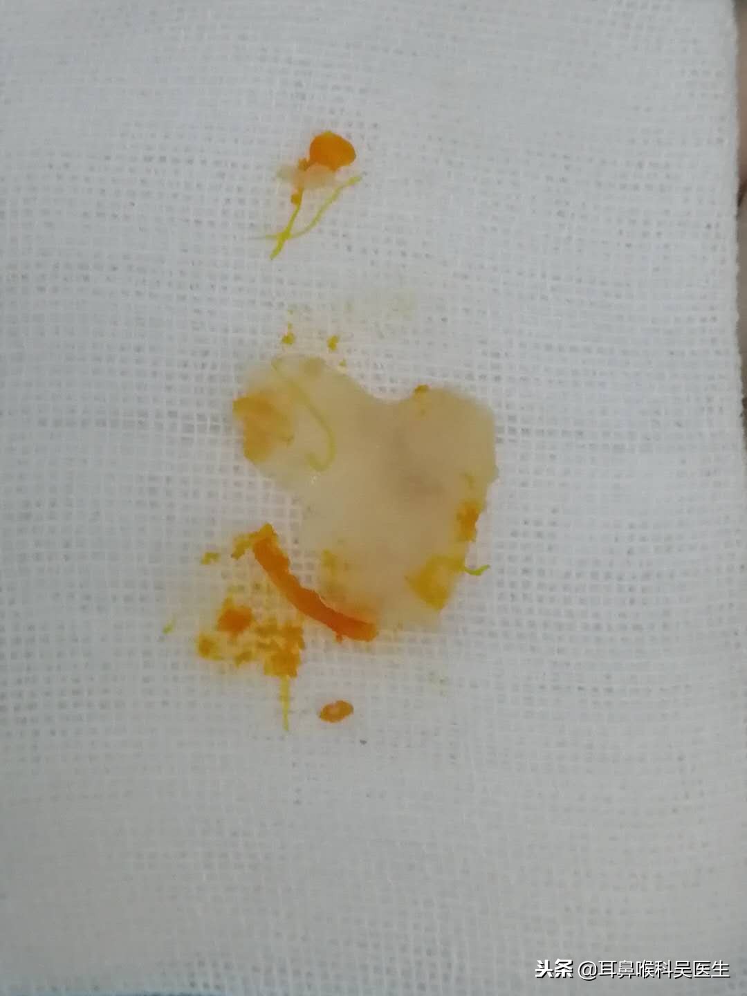 小孩吞异物卡住的症状,被异物卡住了该怎么办