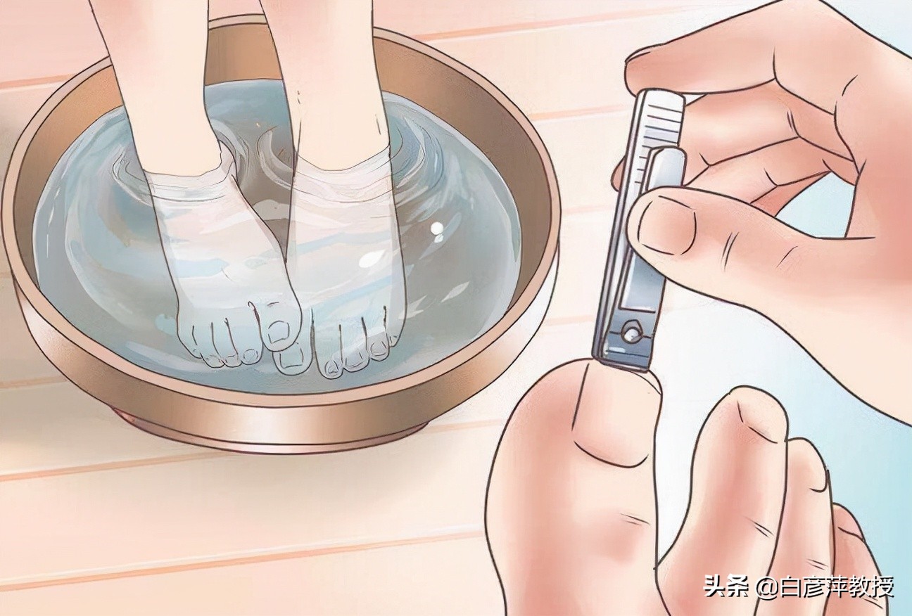 灰指甲是真菌怕晒吗,灰指甲一定是灰色的吗