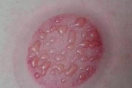 308治疗白癜风皮肤变黑怎么办,白癜风照308后发痒是怎么回事