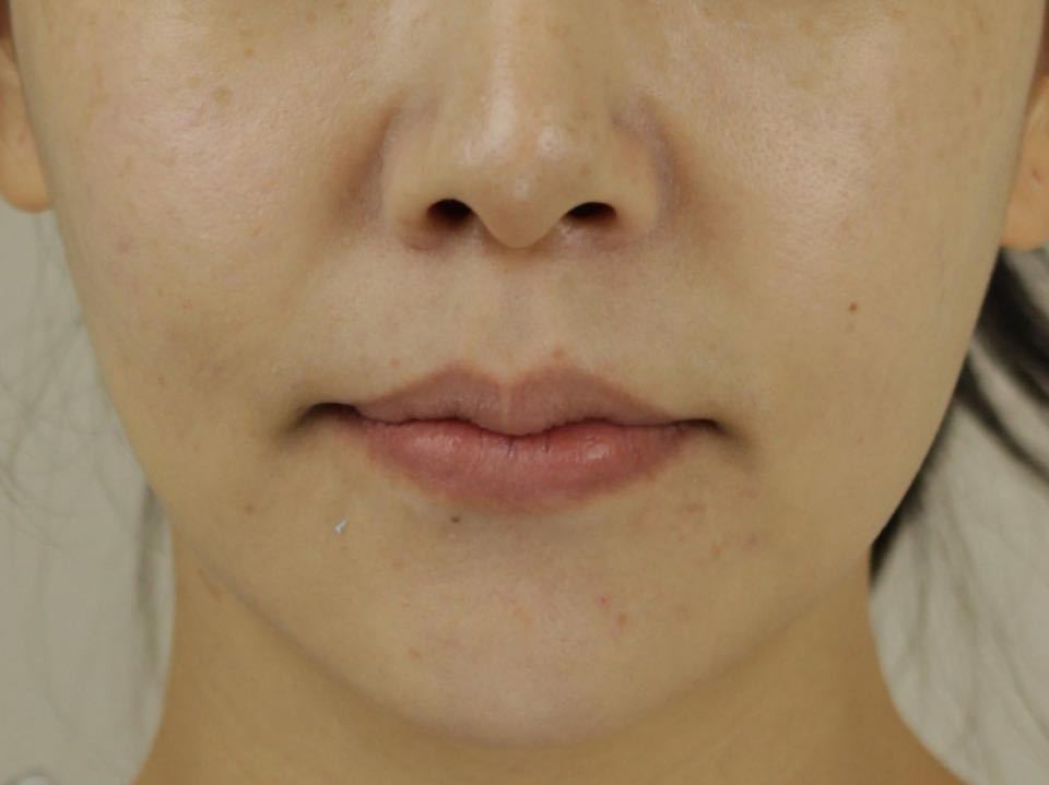 西安张军正畸医生如何,西安牙齿矫正案例