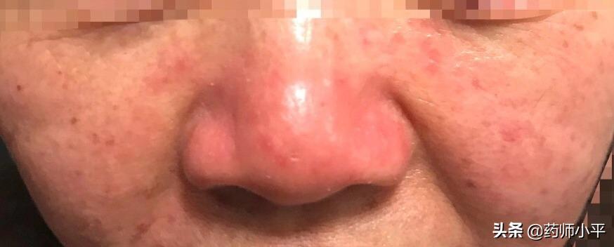 面部发红过敏是什么原因,脸部螨虫过敏起红疹发烫