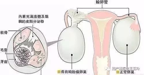 小女孩肚子里长畸胎瘤的原因,14岁女孩长出胎瘤