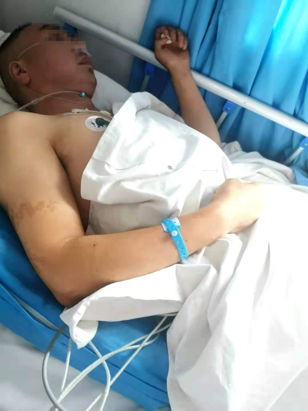 身体若出现5个前兆，十有八九被“脑梗”盯上了，请及早就医