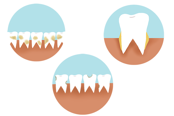牙缝里面抠出来像石头一样的东西,牙缝中抠出的黄泥