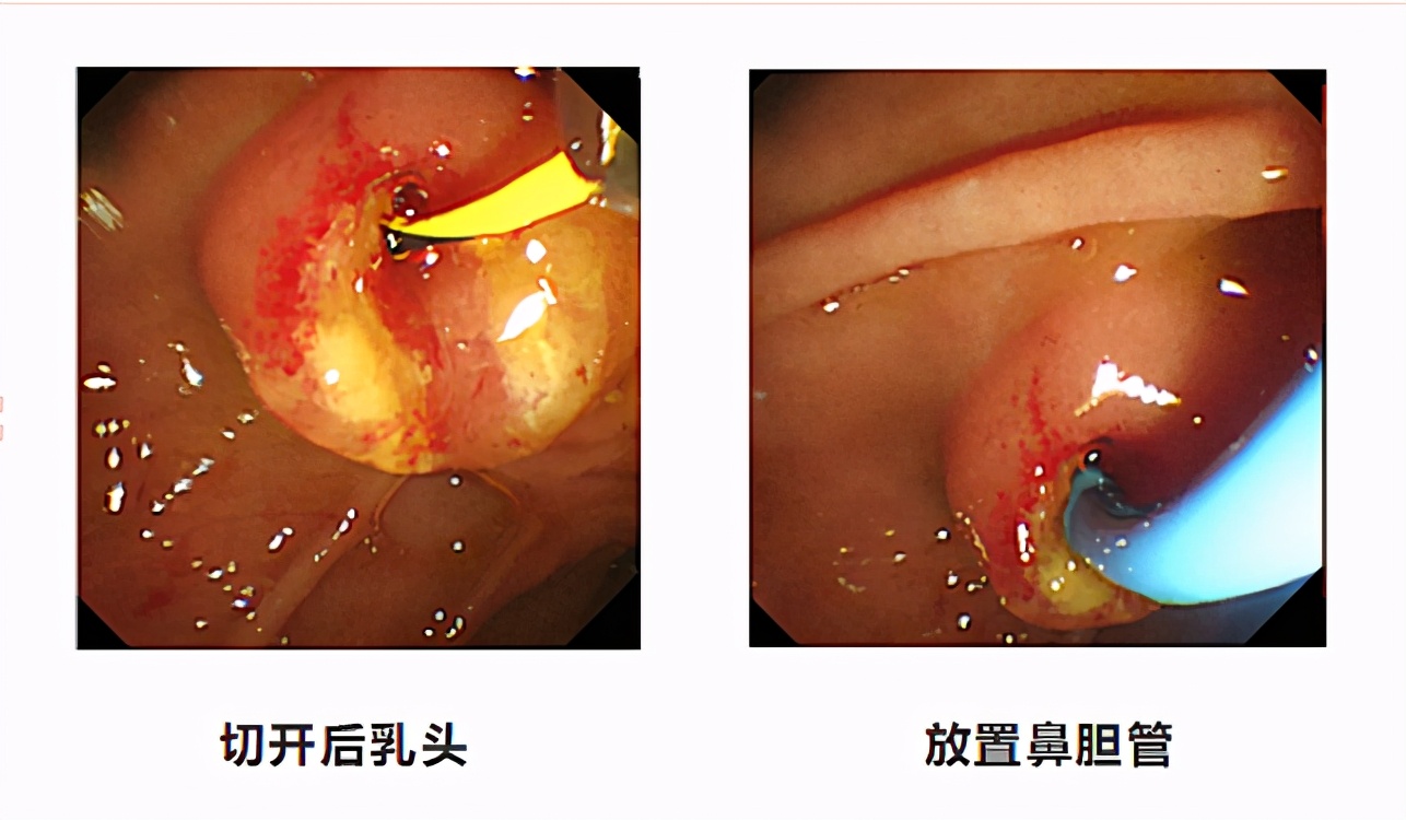 肝内胆管结石微创取石需要住院吗,肝内胆管结石腹腔镜取石