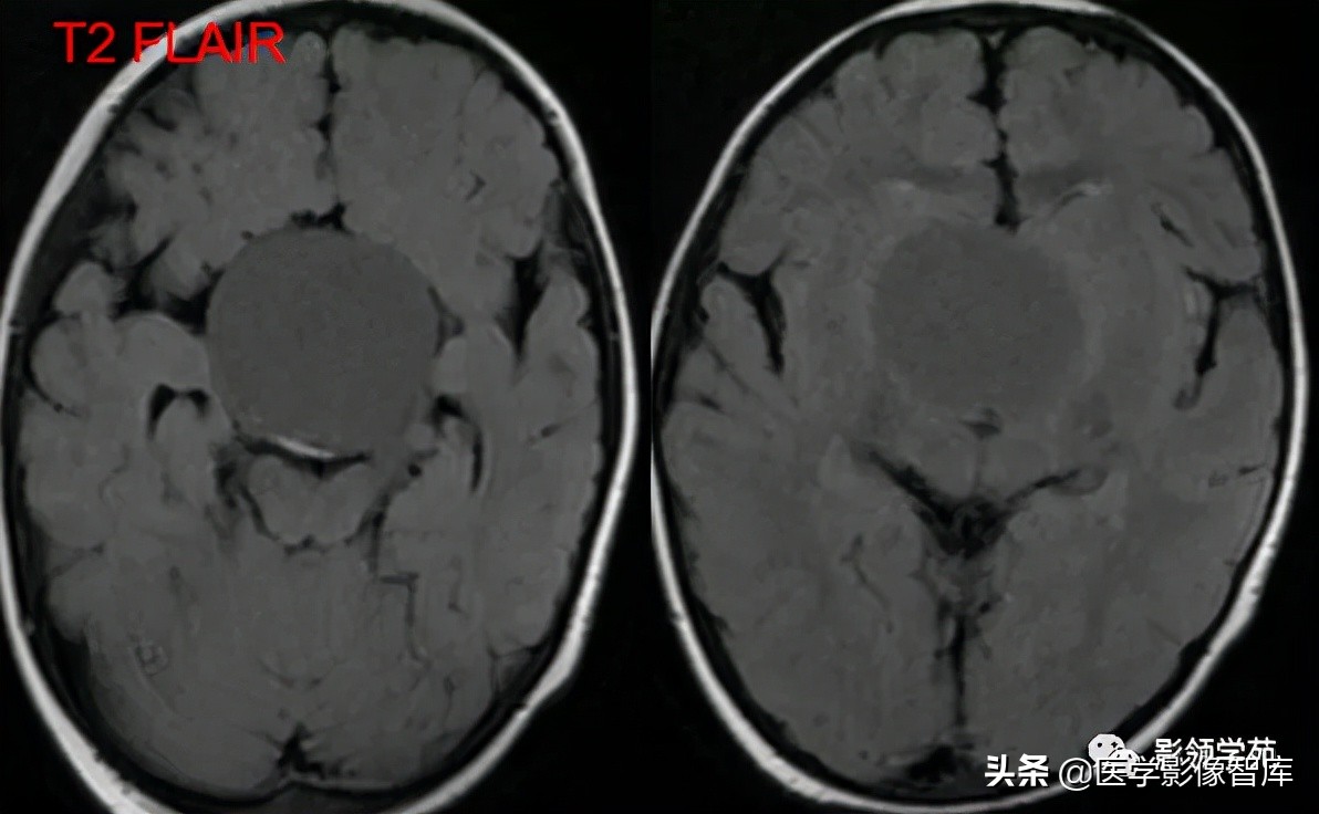 鞍区肿瘤做什么检查得出来,鞍区肿瘤的影像学鉴别