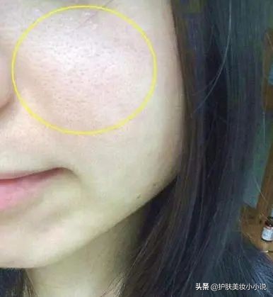 螨虫钻进皮肤怎么办,螨虫毛孔粗大擦什么药