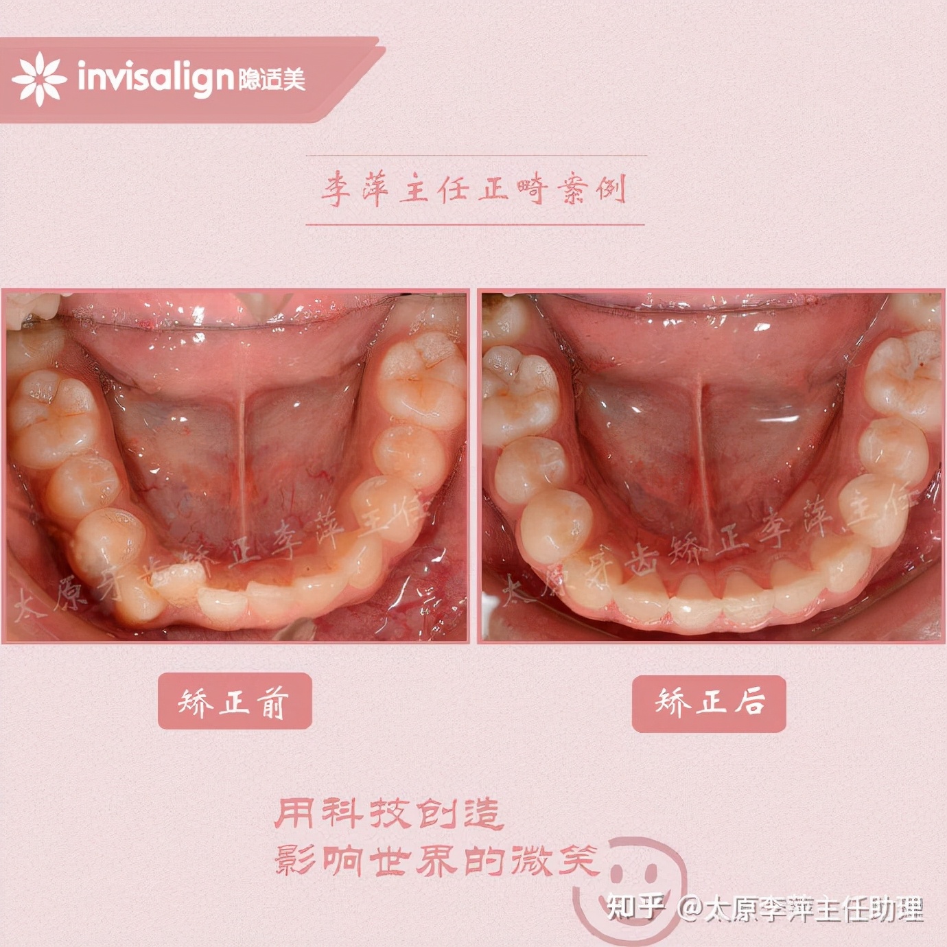 太原牙齿矫正靠谱吗,太原成人隐形牙套牙齿不齐