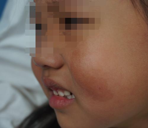 小小咖啡斑，童年“拦路虎”