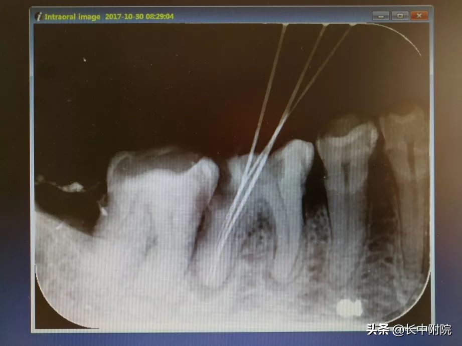 口腔根管治疗技术,口腔根管治疗怎么学好