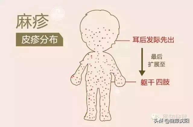 健康教育麻疹防治知识,健康科普反复荨麻疹会引起什么病