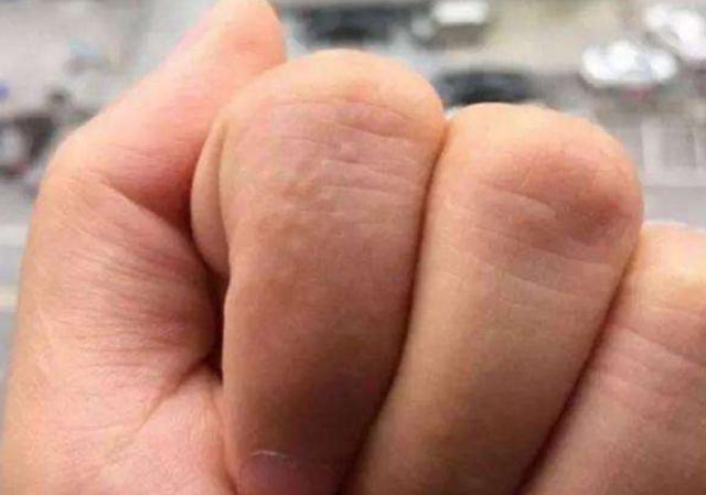 为了避免手上起水泡该怎么预防,一到天热手上起水泡脱皮