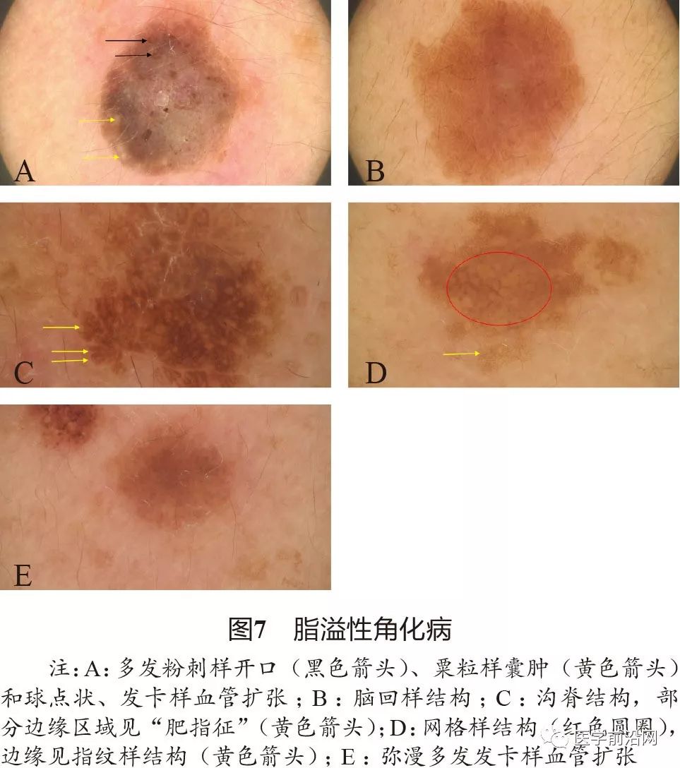 面部常见皮肤病皮肤镜诊断专家共识全文发布