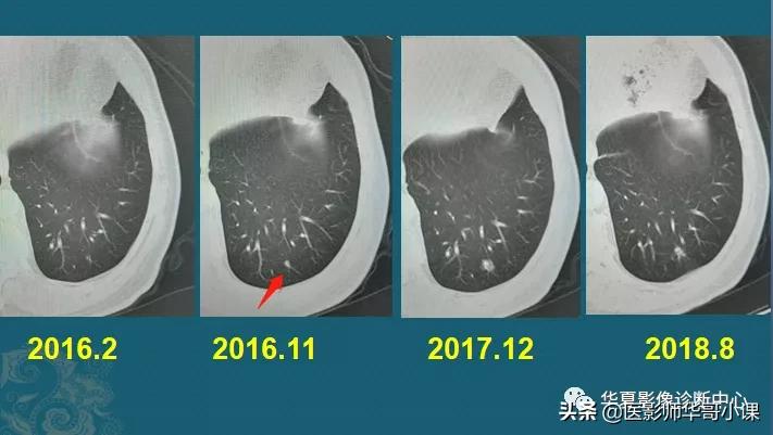 小细胞肺癌早期ct表现为什么结节,肺部ct显示有三处2cm结节是肺癌么