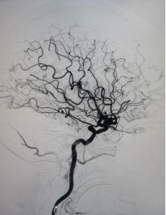 Tubridge®治疗多发性动脉瘤