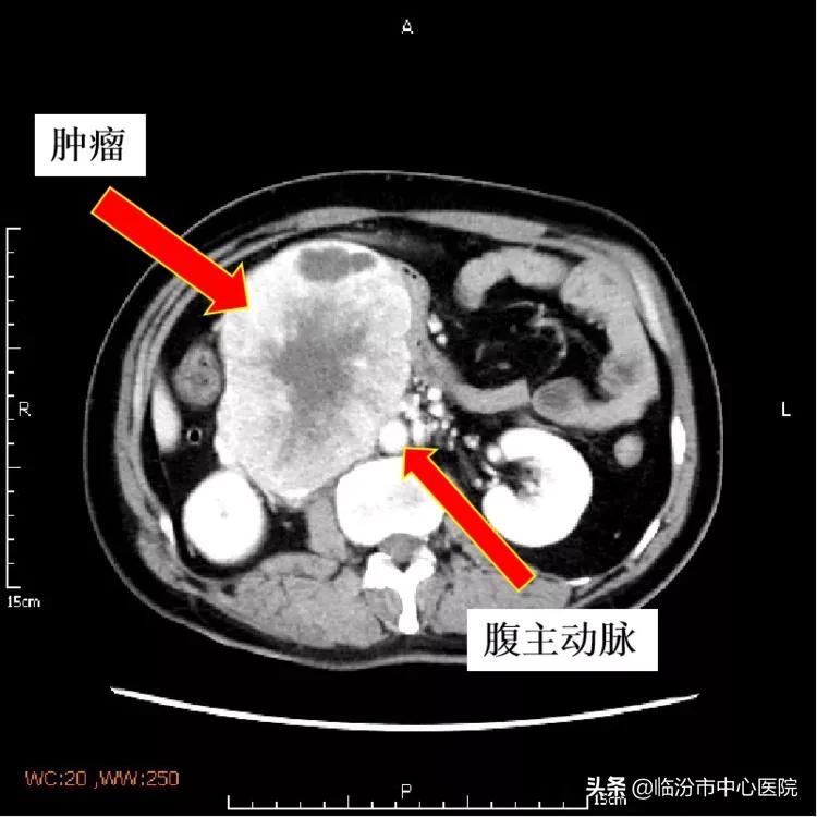 临汾市中心医院手术,临汾市中心医院腹腔镜手术