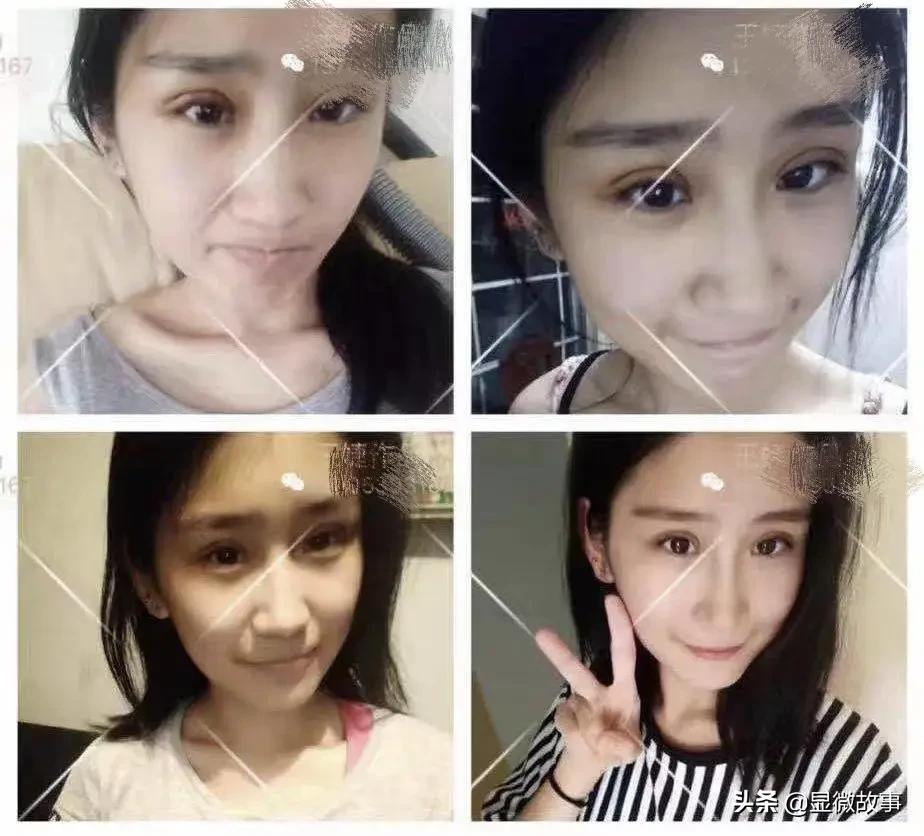 整容垫鼻,鼻子整容毁容取假体