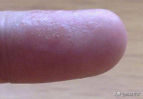 糖尿病的皮肤病变有哪些常见症状,糖尿病皮肤病变的10个征兆