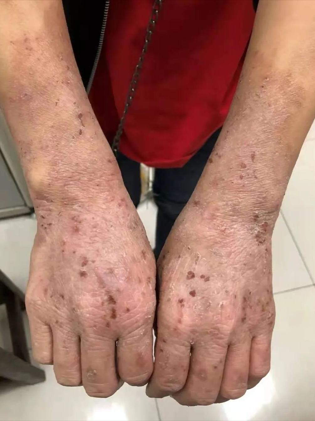 脚气会通过床单传染吗,脚气到底是怎么传染的