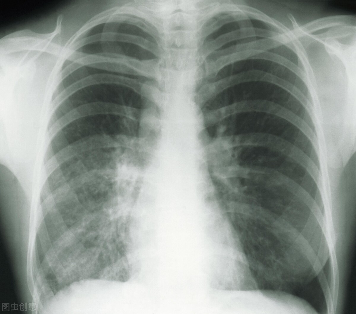 中药到底能不能消散结节？1个真实病例告诉你答案（内附图片）