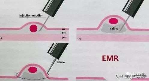 胃息肉在线解答,胃息肉科普视频参赛作品