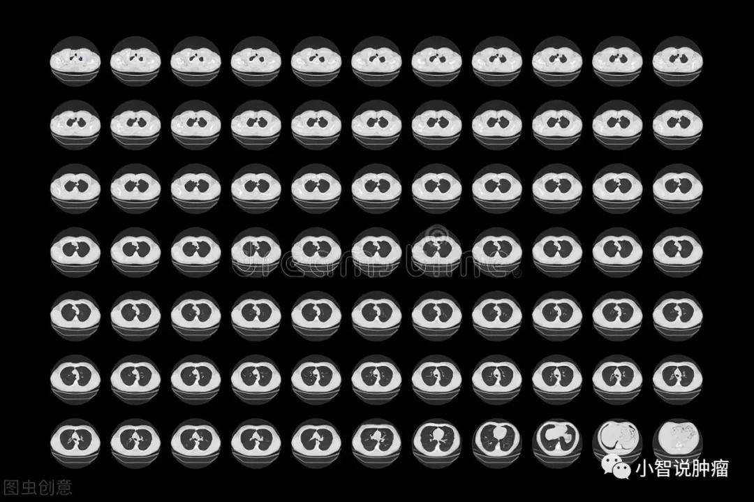 年年体检，忽然被告知肺癌晚期！早期筛查真的有用吗？