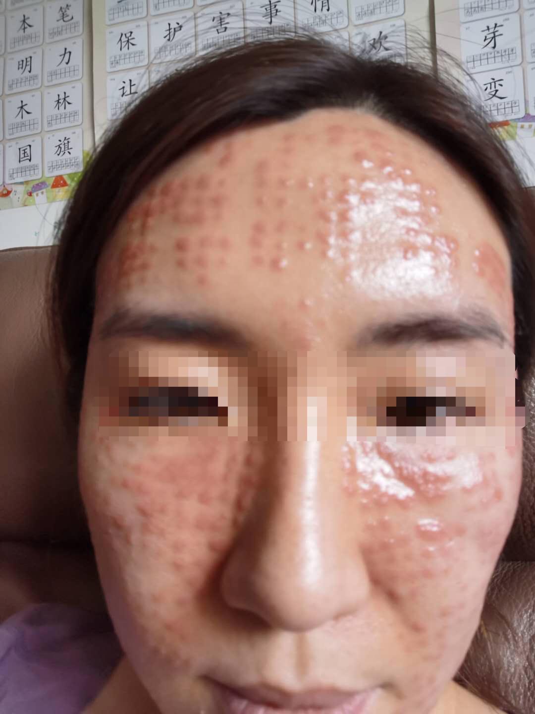 一次水光针需要2000多针吗,一次水光针等于100片面膜