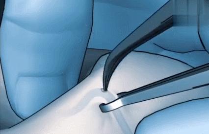 男女双方结扎各自扎哪里？如何更“*福性**”？