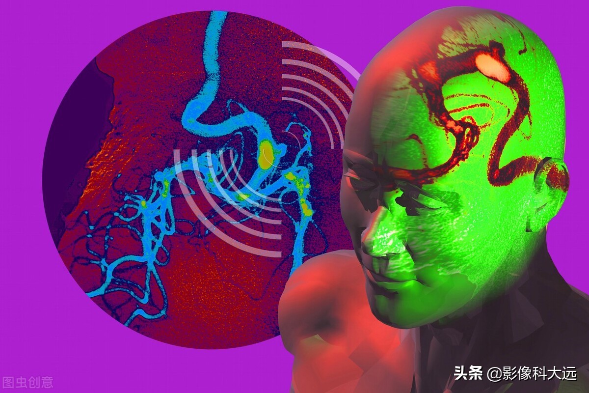 解放军总医院郭伟：90%以上的主动脉夹层病人都有剧烈疼痛