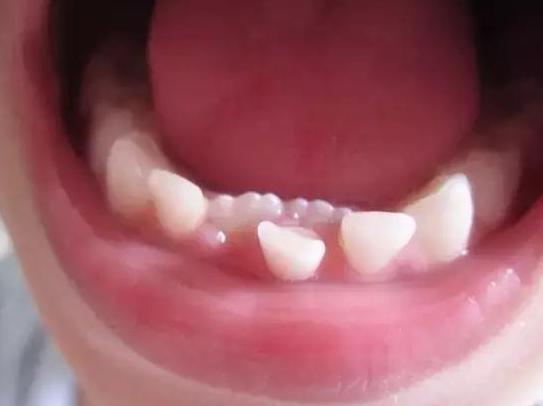 七类牙医,为什么医生不建议拔7号牙齿