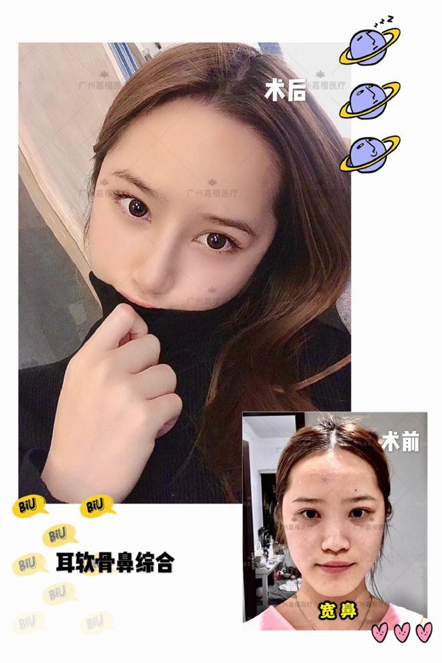 隆鼻手术十大常见问题的应对方案,隆鼻手术前应该准备带什么东西