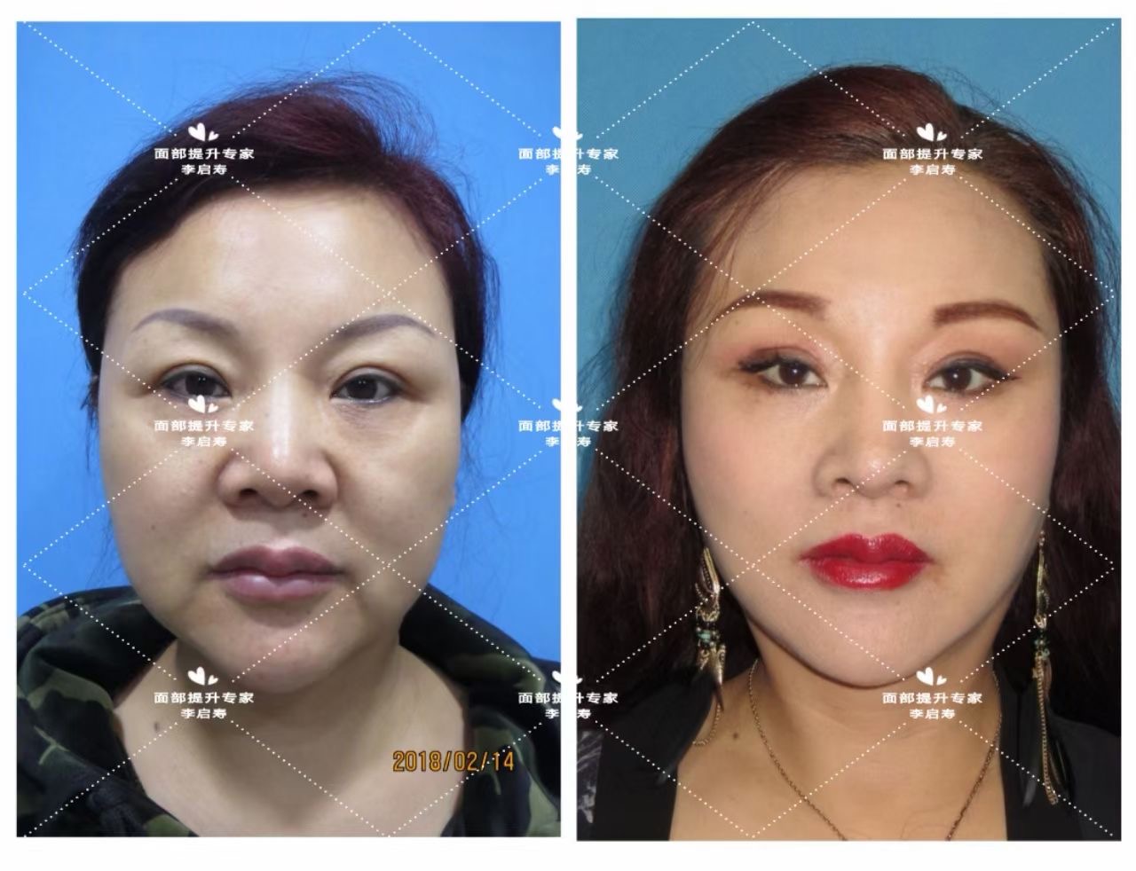 美容仪是真有用还是智商税呢,美容仪有用吗是智商税吗真实测评