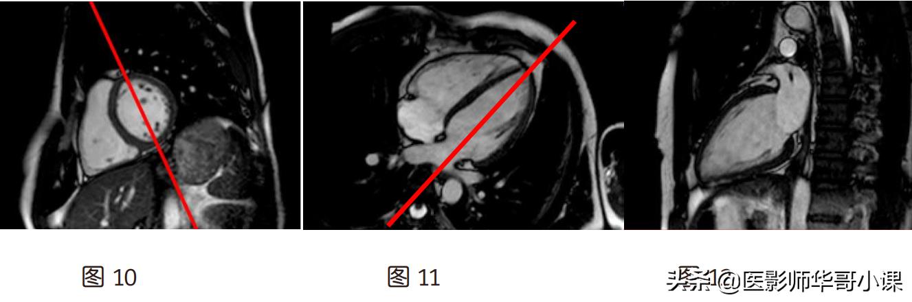 磁共振心脏扫描标准切面,心脏mri扫描定位