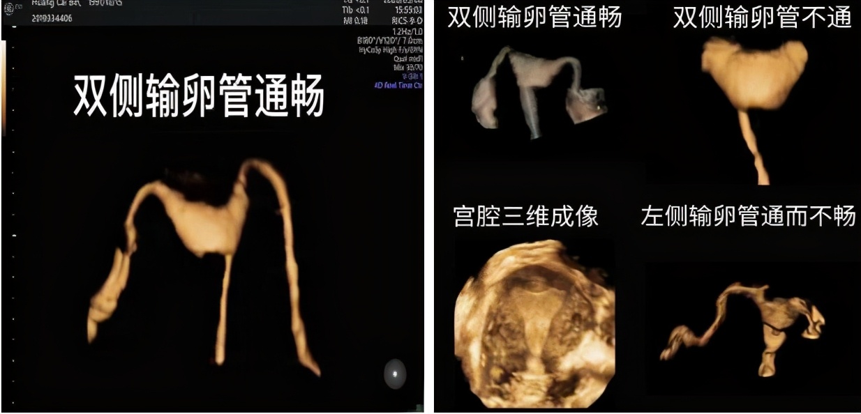 四维子宫输卵管超声造影术,子宫输卵管三维超声造影检查过程