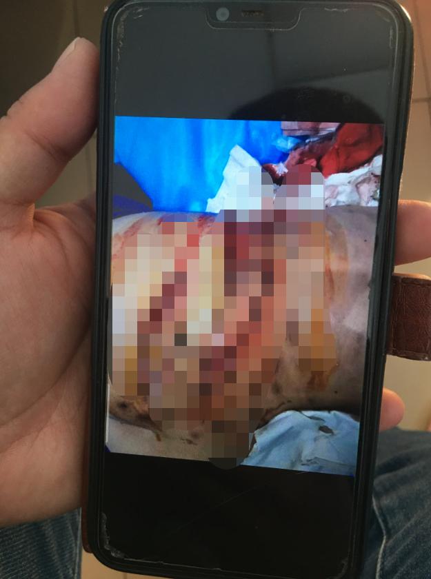 河南杞县115人针灸后针眼溃烂：针灸前被注射药物，事发后仍有人苦求继续针灸，患者需手术切开伤口排脓