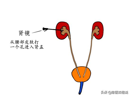 发现肾结石怎样治疗更好,发现肾结石怎么办