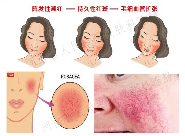 过敏脸上身上全是红痘痘,脸红就是玫瑰痤疮吗