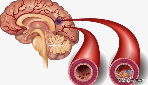 62岁男子突发脑梗52分钟紧急溶栓,男子脑梗倒地医生急救