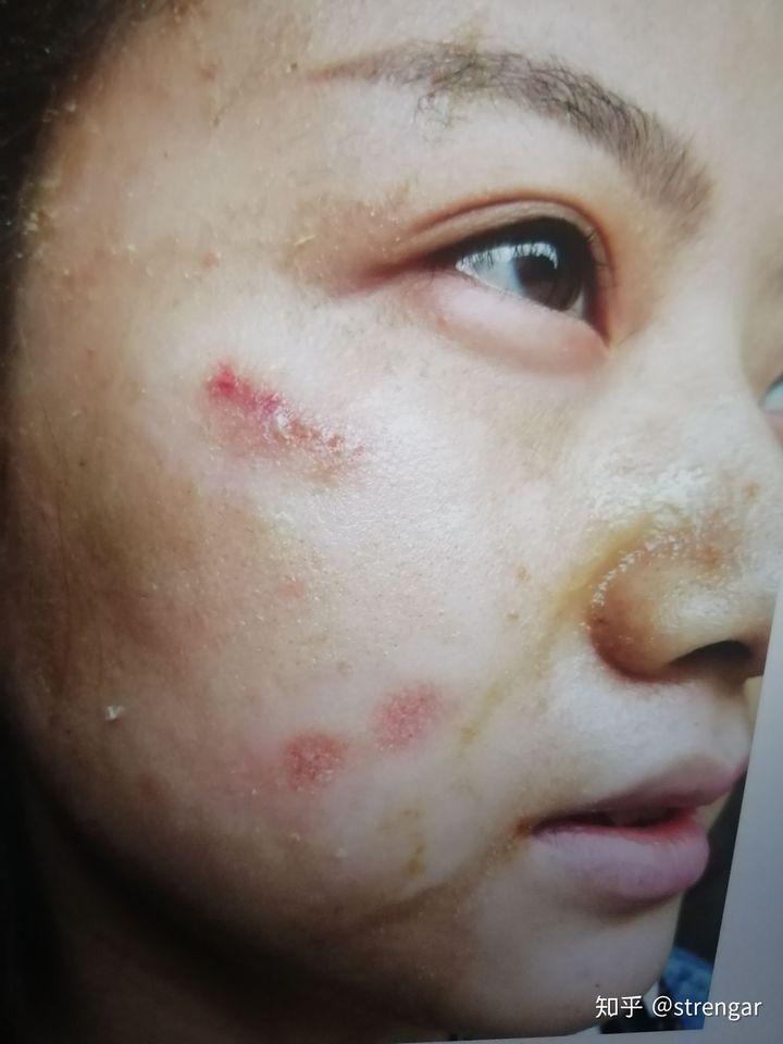 陈金西细胞祛疤真实性,陈金西细胞种植毁容