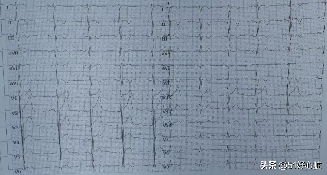 心肌酶高会引起胸闷胸痛吗,突发心肌梗塞是什么原因引起的