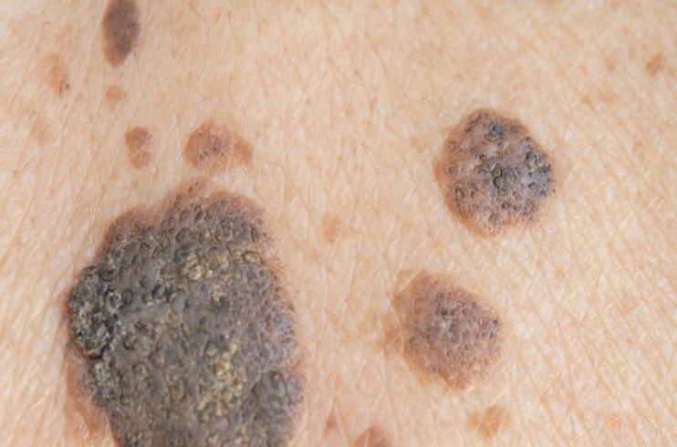 痣恶变前的3个征兆,痣的恶变会有征兆吗